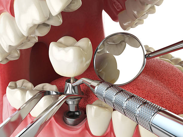 Emergency Dental Filling Replacement in MD